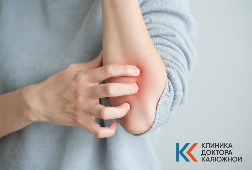 Аллергия Аллергическая реакция